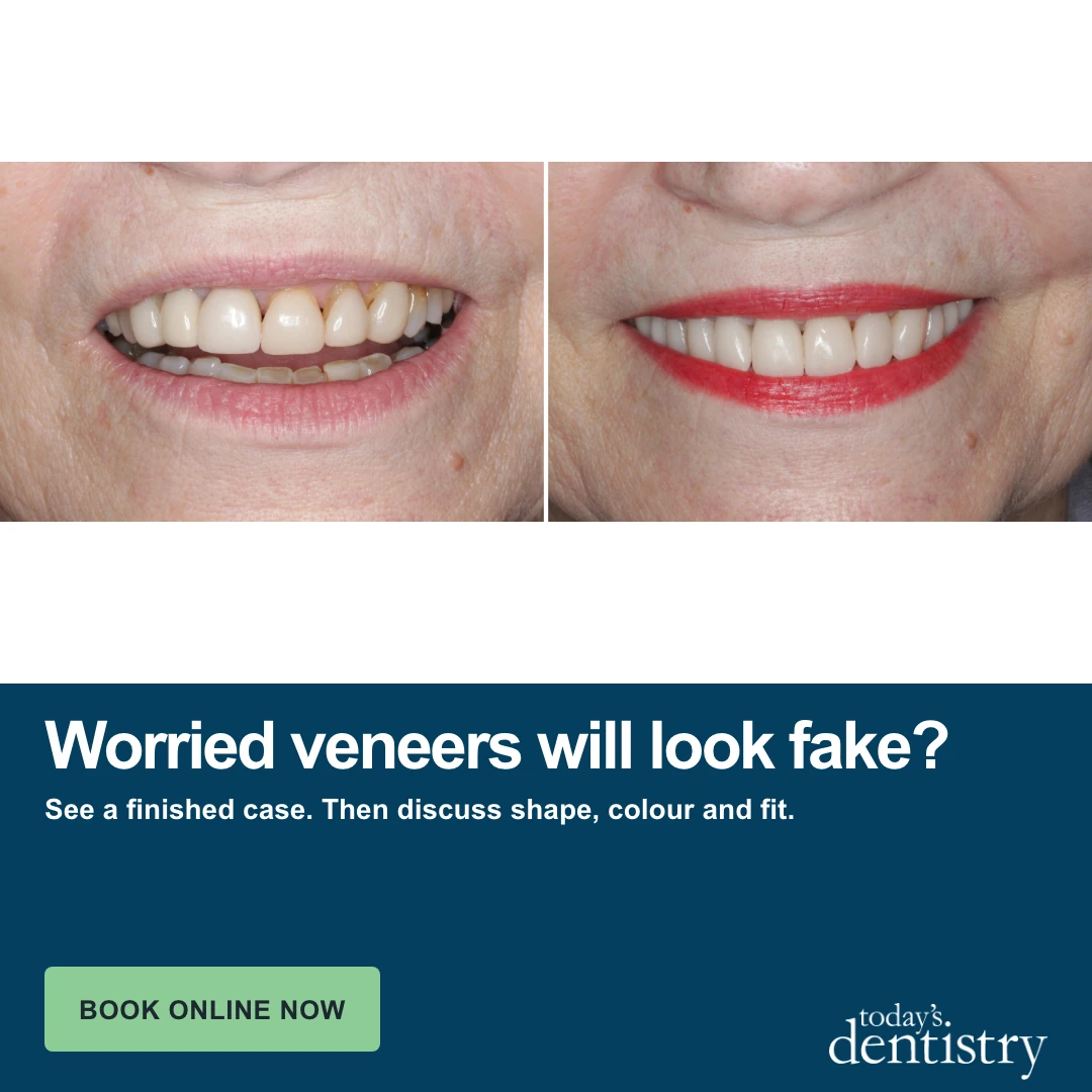 Worried veneers will look fake? ad creative